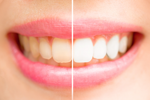 5 COMMON CAUSES OF YELLOW TEETH