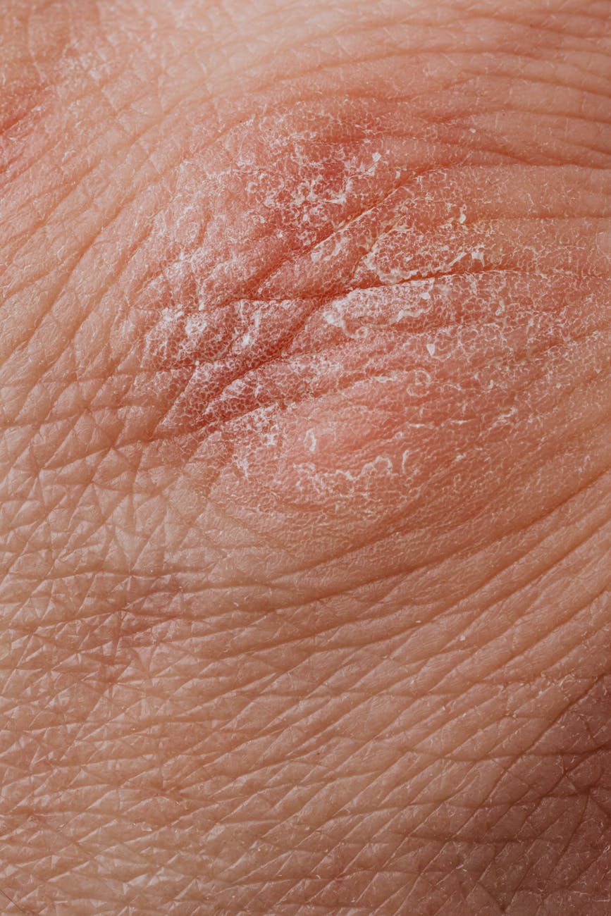A Guide to Recognizing Morgellons Disease - Suncoast News and Weather